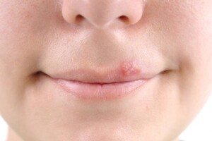 Herpes - təbii üsullarla müalicəsi